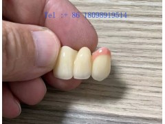 深圳义齿加工、烤瓷牙加工、全瓷牙加工、种植牙加工、牙齿加工厂