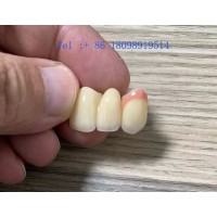 深圳义齿加工、烤瓷牙加工、全瓷牙加工、种植牙加工、牙齿加工厂
