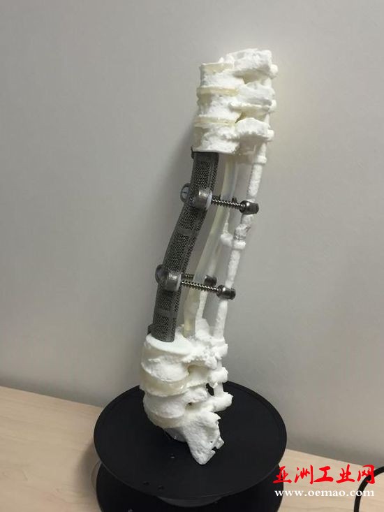 北医三院完成世界上首个3D打印脊椎手术