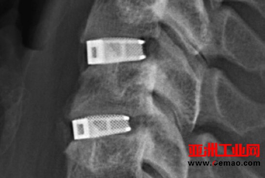 EIT的3D打印CellularTitanium椎间融合器获FDA批准