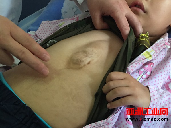 六龄童心脏“吊”胸前像挂饰，上海医生用3D打印修复其胸骨